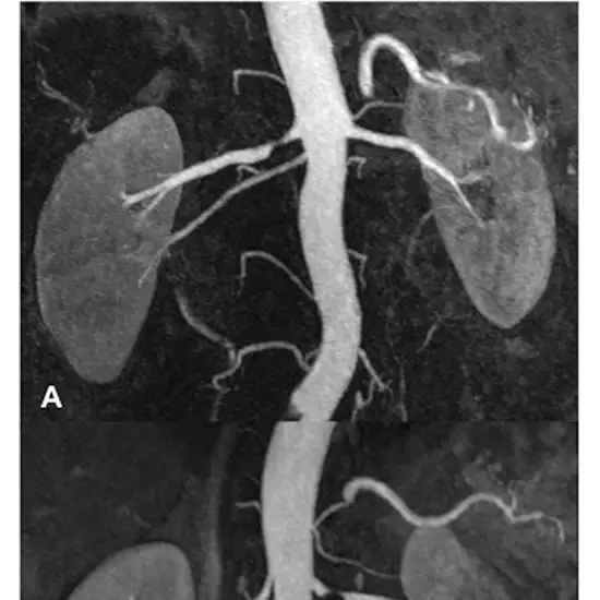MR Angiography Renal Arteries